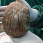 1 3kg Bladder Stone Removed From Man After Years Of Silent Suffering