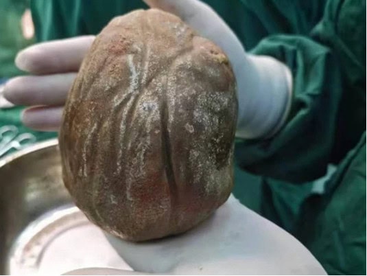 1 3kg Bladder Stone Removed From Man After Years Of Silent Suffering